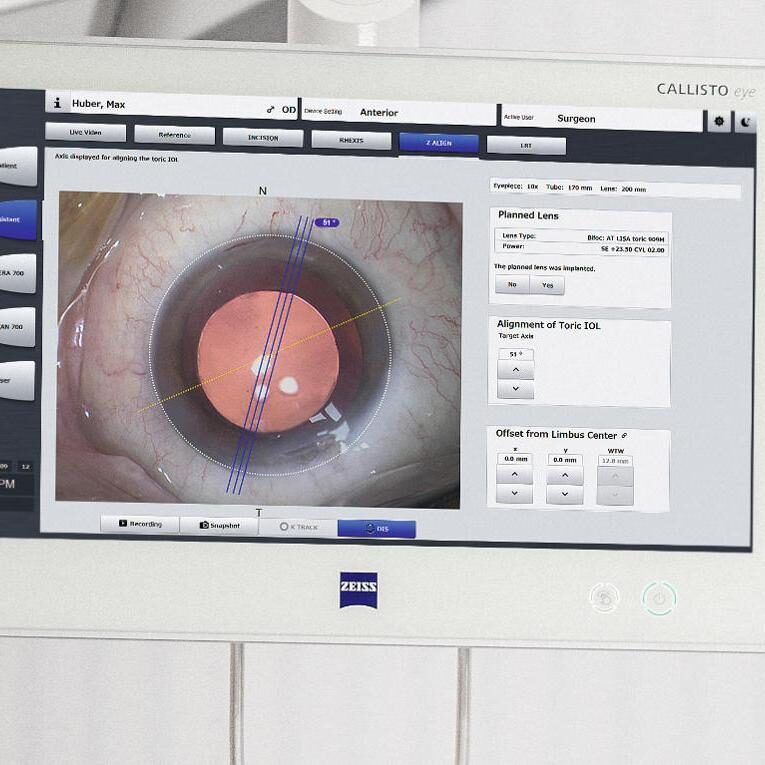 Biometría y Cálculo de Lente Intraocular