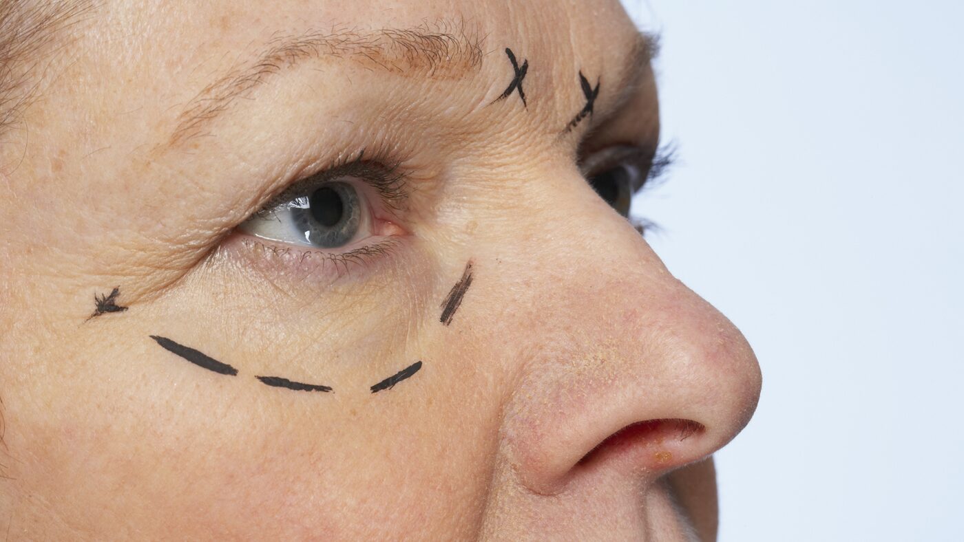 Oculoplastia o Plástica Ocular
