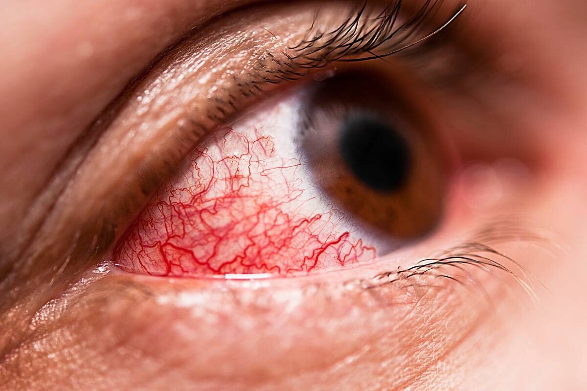 Conjuntivitis