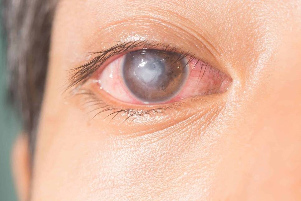 Úlcera Corneal