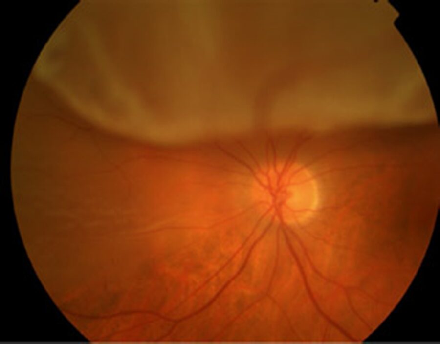 Desprendimiento de Retina