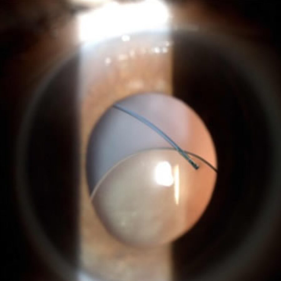 Luxación de Lente Intraocular