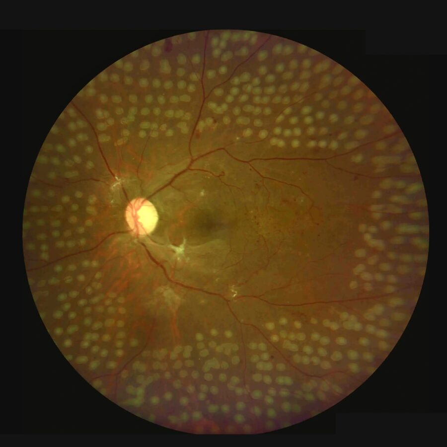 Retinopatía Diabética y Oclusiones Vasculares