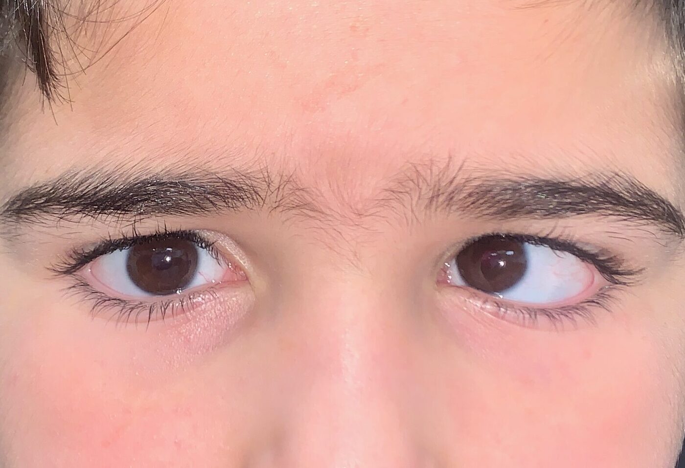 Estrabismo