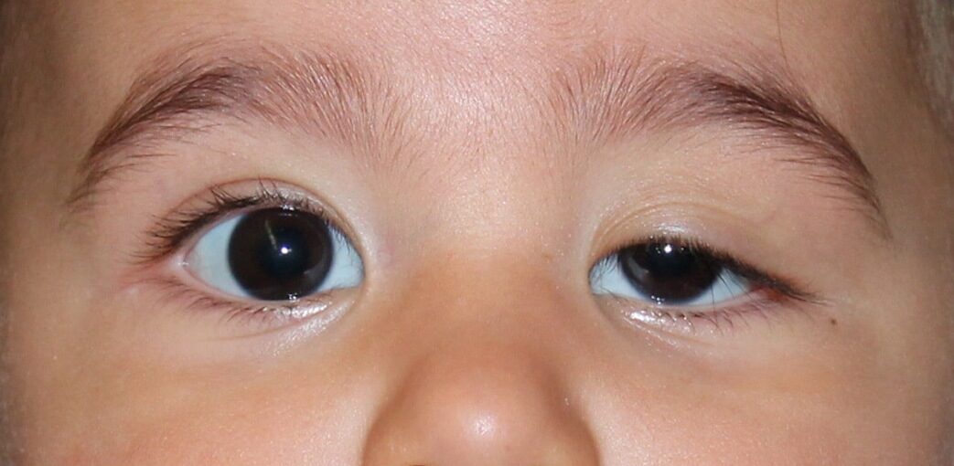 Ptosis Palpebral Infantil