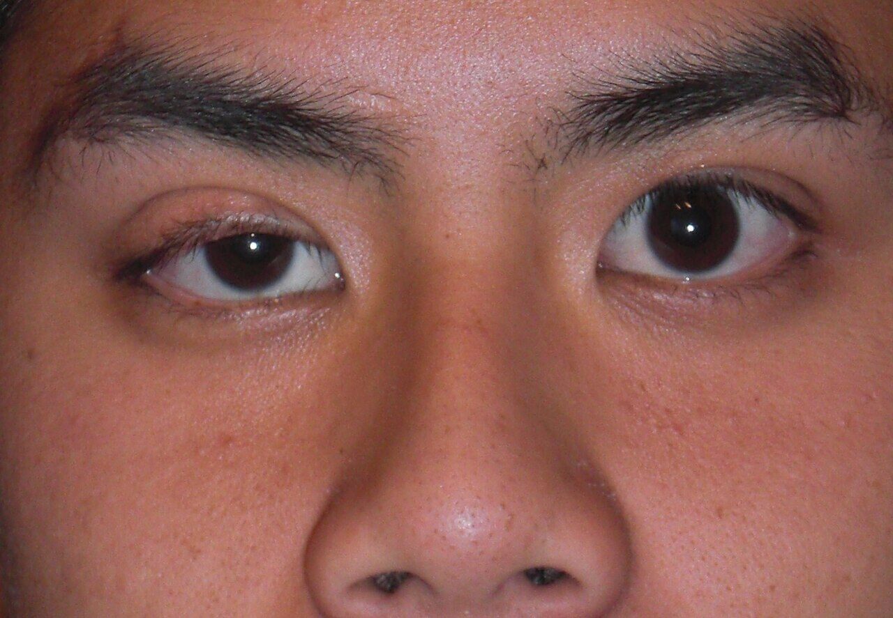 Ptosis Palpebral