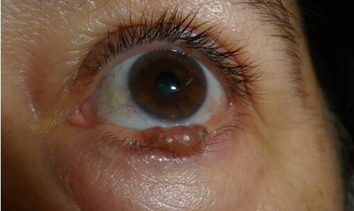 Tumores Palpebrales
